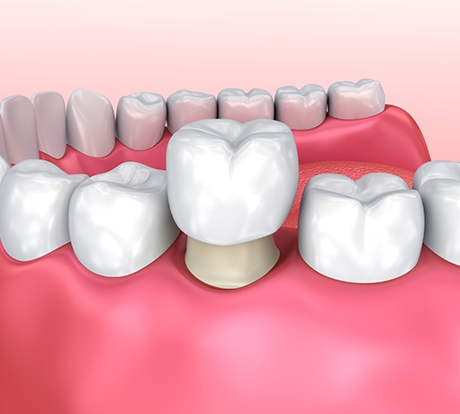 A 3D illustration of a dental crown being placed over a tooth
