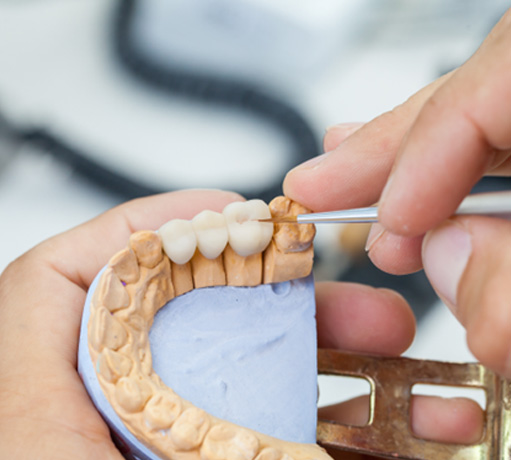 Model of the mouth with a dental bridge replacing three teeth