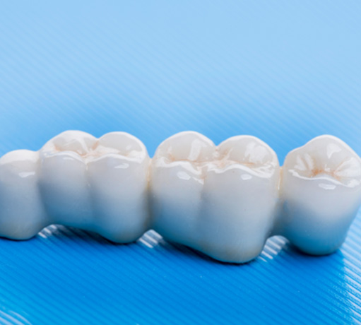 Five part dental bridge