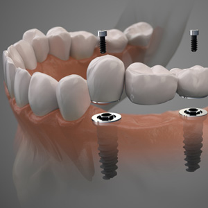 Illustration of two dental implants supporting a three part dental bridge