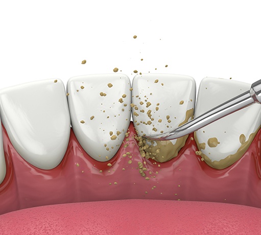 Illustration of scaling instrument removing plaque from teeth