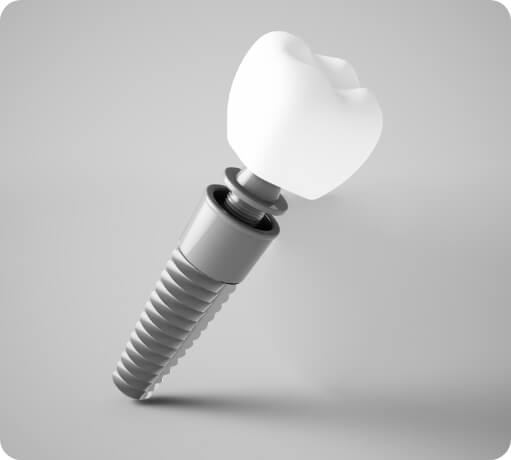 Illustration of a dental implant post with a dental crown