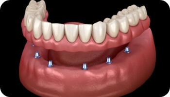 Illustration of a full denture being placed onto six dental implants