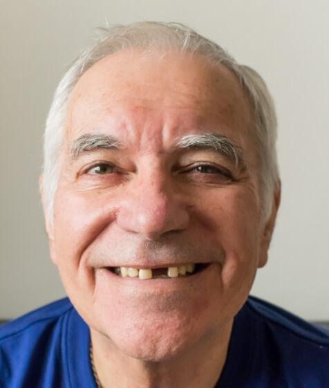 Smiling man missing one upper front tooth