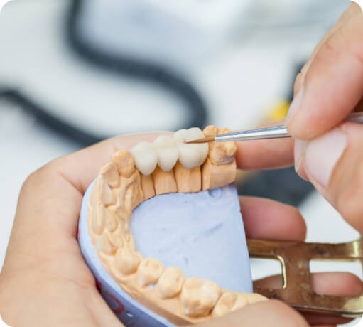 Model of the mouth with a dental bridge replacing three of the teeth