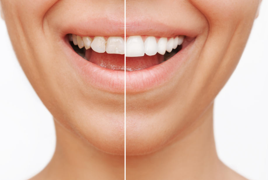 Close up of woman's smile with half veneers, half natural teeth